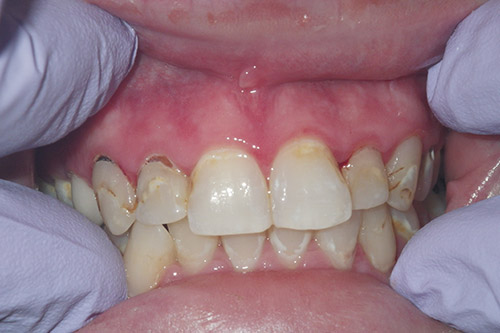 Dalin Dental Before and After - Porcelain Vemeers Before