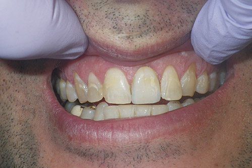 Dalin Dental Before and After -Ceramic Crown After