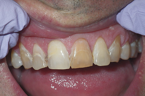 Dalin Dental Before and After -Ceramic Crown Before