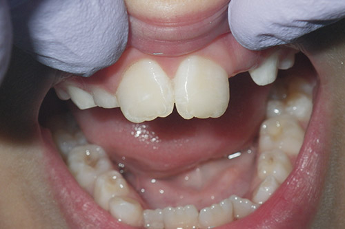 Dalin Dental Before and After - Plastic Fillings After