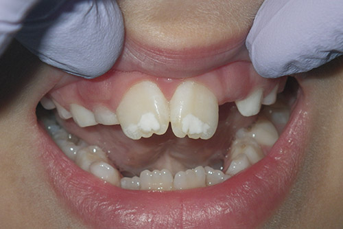 Dalin Dental Before and After - Plastic Fillings Before