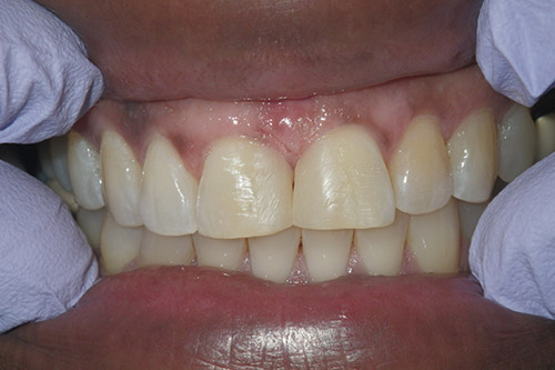 Dalin Dental Before and After - Plastic bond  After