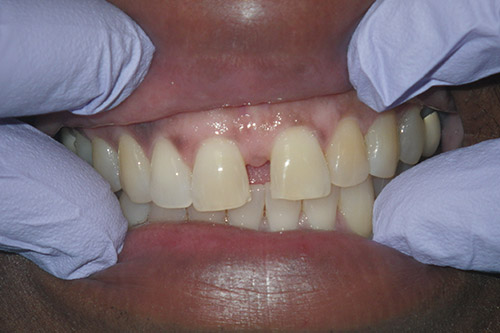 Dalin Dental Before and After - Plastic bond  Before