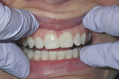 Dalin Dental Before and After - Plastic bond After