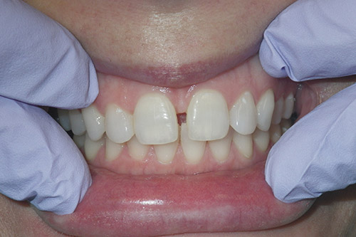 Dalin Dental Before and After - Plastic bond Before