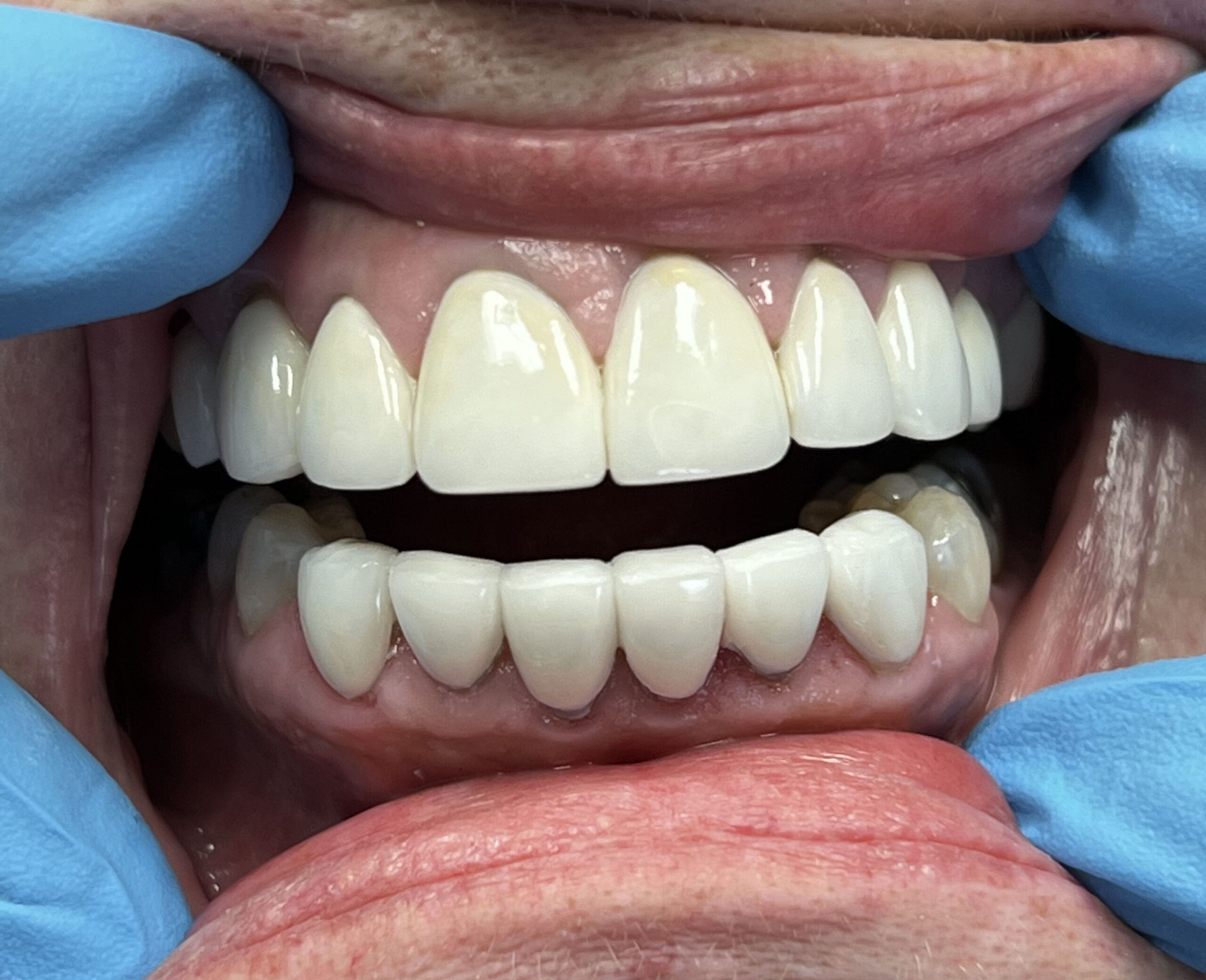 Dalin Dental Before and After - Porcelain Vemeers After