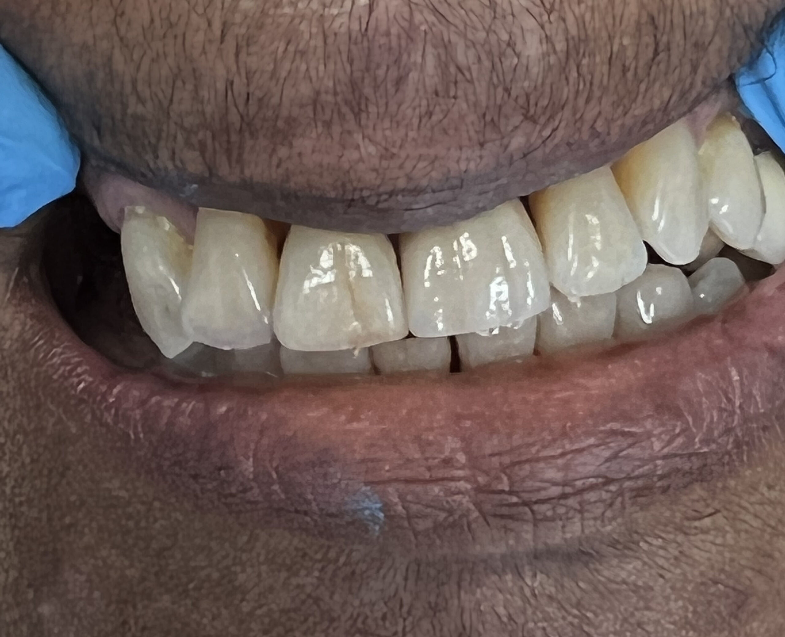 Dalin Dental Before and After - After