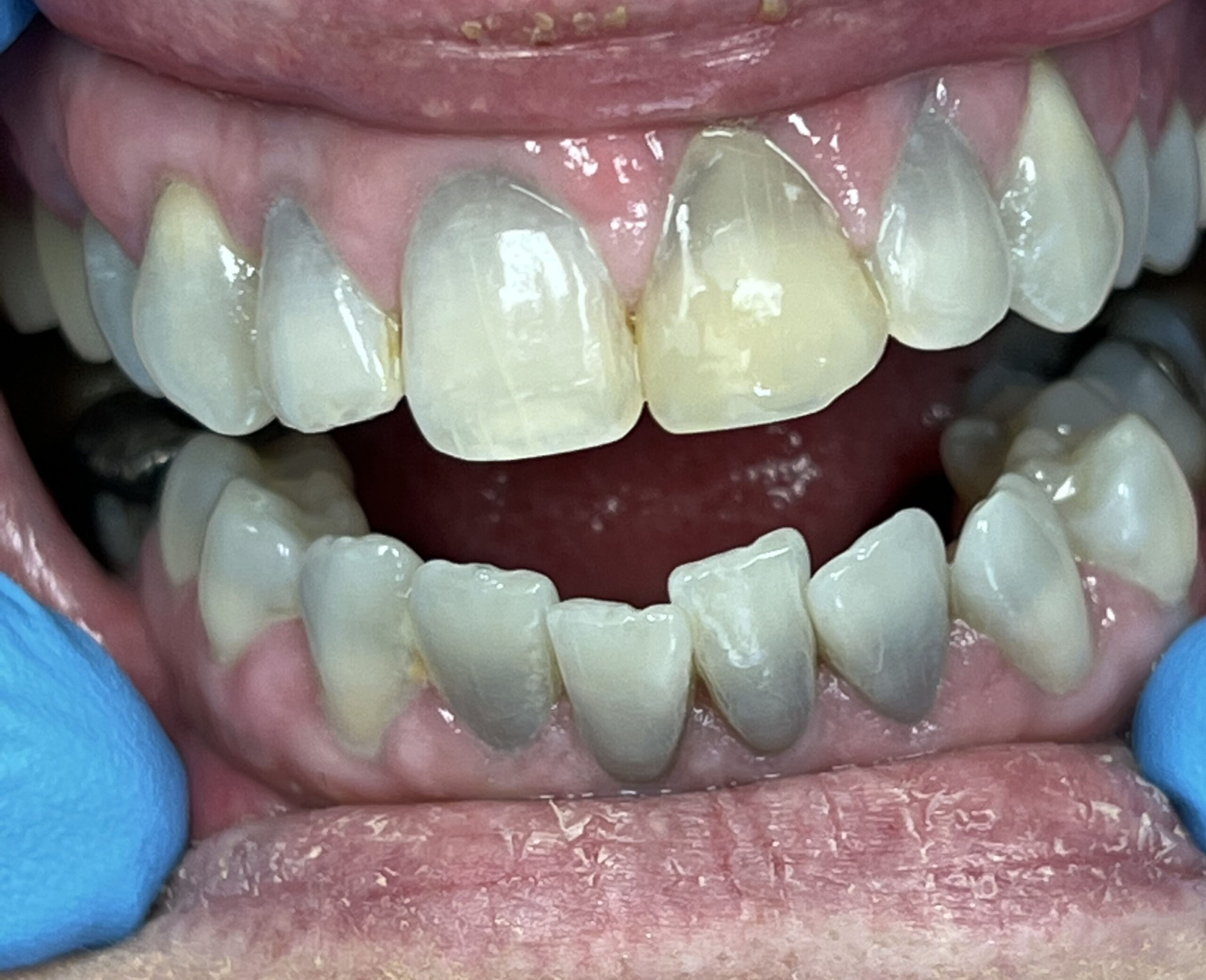 Dalin Dental Before and After - Porcelain Vemeers Before